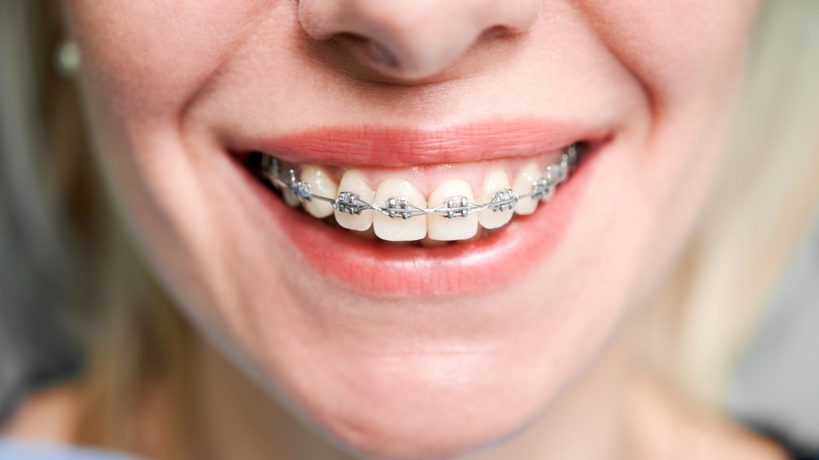 Tipos de aparelho ortodôntico: qual é o ideal para o seu sorriso?