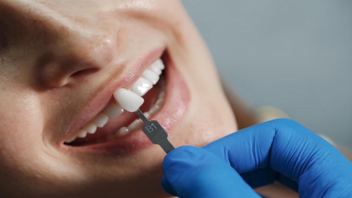 Facetas de resina: estética dental acessível para um sorriso harmonioso