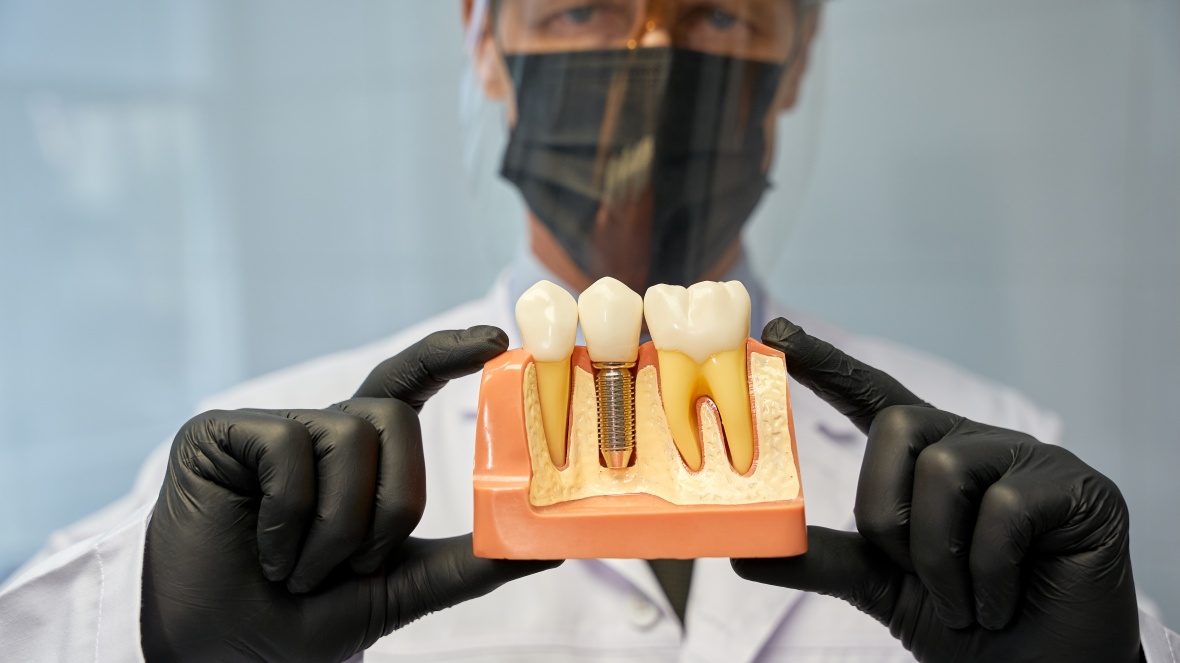 Implante dentário: o que define o preço e por que é um investimento na sua saúde